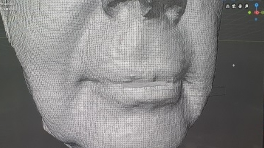 Artec Eva gets up close with facial paralysis and the emotions that lie behind it